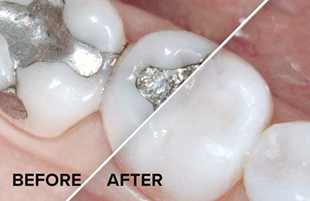 a before and after picture of a composite filling