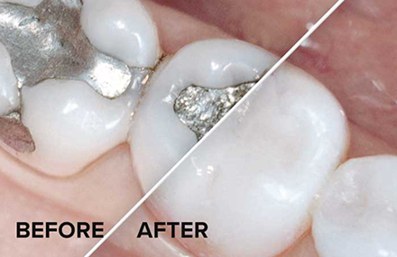 Before and after mercury fillings