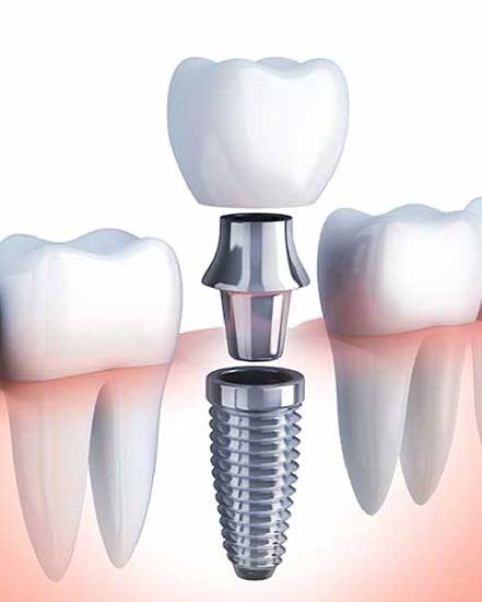 A dental implant