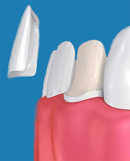 Porcelain veneers