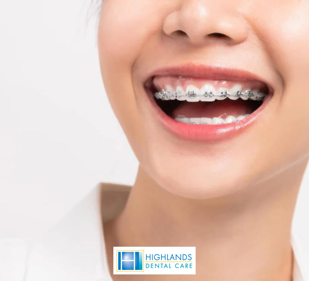 Close-up of traditional metal braces installed on a set of teeth, showcasing orthodontic treatment.